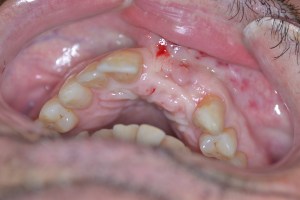 Bone Graft