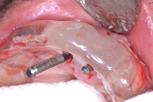 Implant Placements