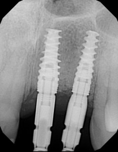 Implant Placements