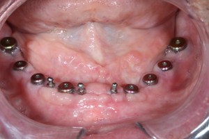 Implant Placements