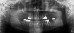 Case #3 Pre-operative