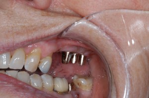 Case #3 Impressions for Crowns #13, 14, 15, 16 and 18