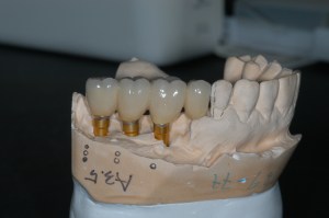 Case #3 Crowns before placement