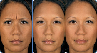 Botox Cosmetic example