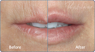 Facial Fillers Example