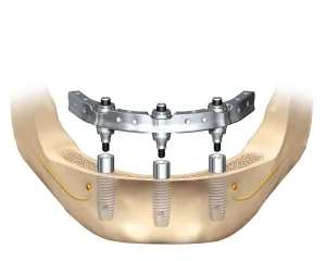Trefoil Dental Implant Technique Illustration