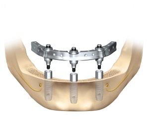 Trefoil Dental Implant Technique Illustration