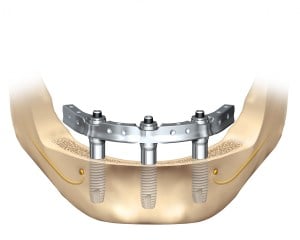 Trefoil Dental Implant Technique Illustration