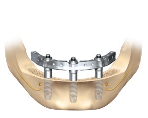 Trefoil Dental Implant Technique Illustration