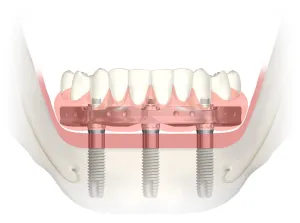 Trefoil Dental Implant Technique Illustration
